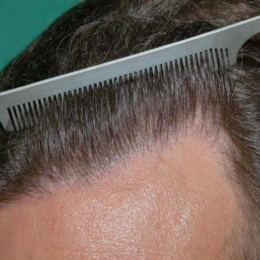 Patient after hair loss retreatment