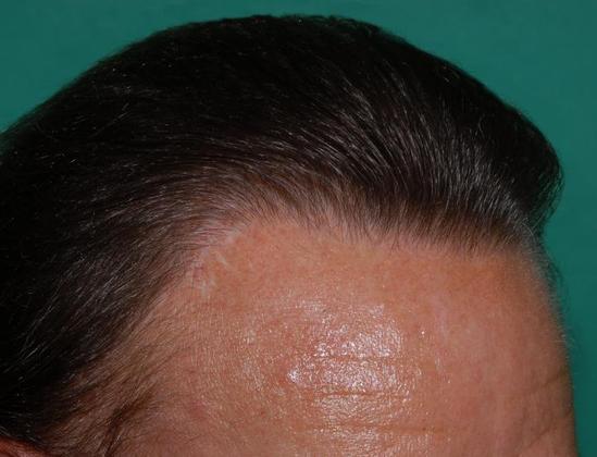 After Frontal-Midscalp Restoration