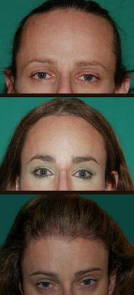 Hair loss surgery before and after front view